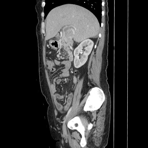 Acinar cell carcinoma of the pancreas (Radiopaedia 75442-86669 Sagittal C+ portal venous phase 69).jpg