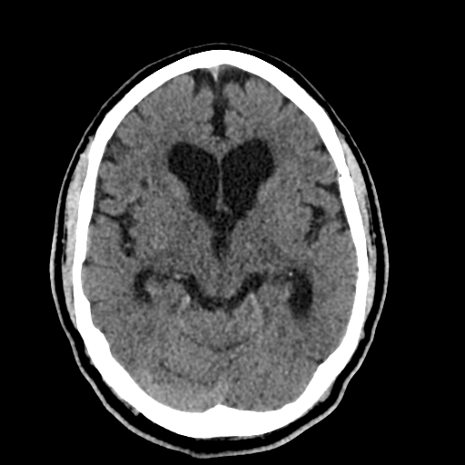File:Acoustic schwannoma (Radiopaedia 55729-62280 Axial non-contrast 16).png