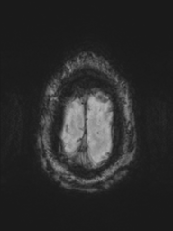 File:Acoustic schwannoma (Radiopaedia 55729-62281 Axial SWI 49).png