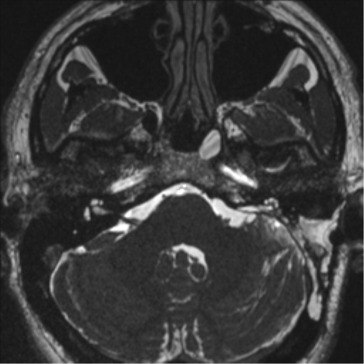 Acoustic schwannoma (translabyrinthine resection) (Radiopaedia 43570-46972 Axial CISS 25).png