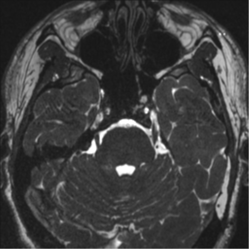 Acoustic schwannoma (translabyrinthine resection) (Radiopaedia 43570-46972 Axial CISS 41).png