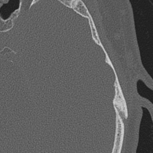 Acoustic schwannoma - cystic (Radiopaedia 29487-29980 AXIAL LEFT bone window 52).jpg
