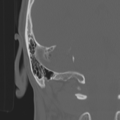 Acoustic schwannoma - eroding petrous apex (Radiopaedia 39674-42002 Coronal bone window 46).png