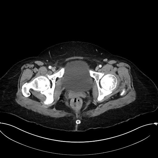 Active Crohn disease (Radiopaedia 59394-66750 Axial C+ portal venous phase 69).jpg