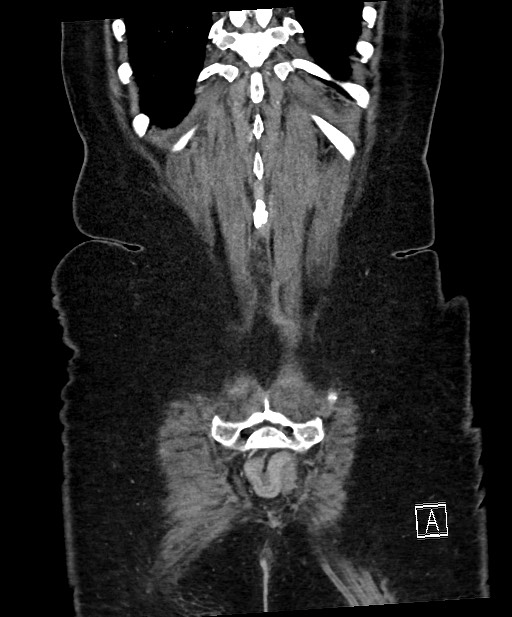 Active Crohn disease (Radiopaedia 59394-66750 Coronal C+ portal venous phase 62).jpg