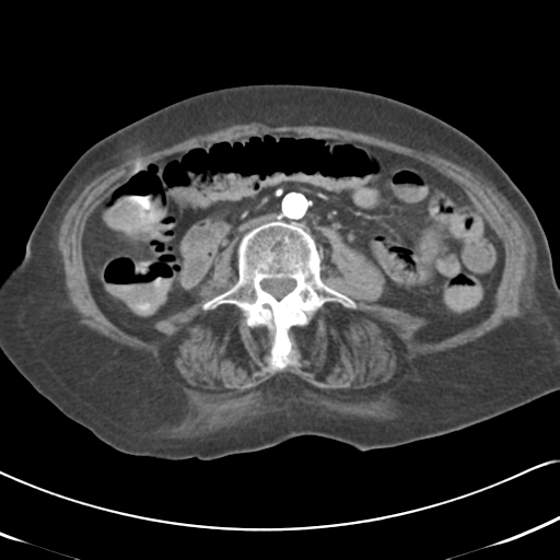 File:Active bleeding from duodenal ulcer with embolization (Radiopaedia 34216-35481 Axial C+ arterial phase 33).png