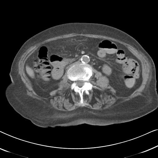 Active bleeding from duodenal ulcer with embolization (Radiopaedia 34216-35481 Axial non-contrast 31).png