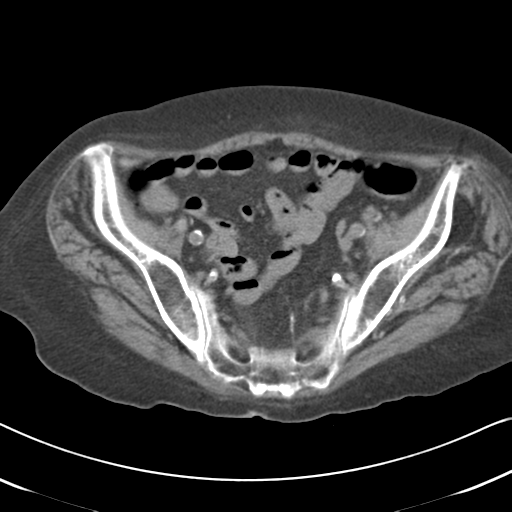 File:Active bleeding from duodenal ulcer with embolization (Radiopaedia 34216-35481 Axial non-contrast 52).png