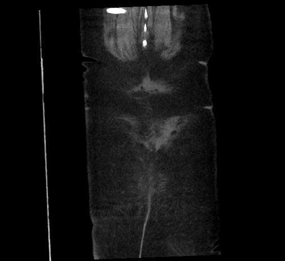 Active renal extravasation with large subcapsular and retroperitoneal hemorrhage (Radiopaedia 60975-68796 Coronal C+ arterial phase 142).jpg