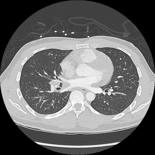 File:Active right ventricular cardiac sarcoidosis (Radiopaedia 55596-62101 Axial lung window 25).jpg