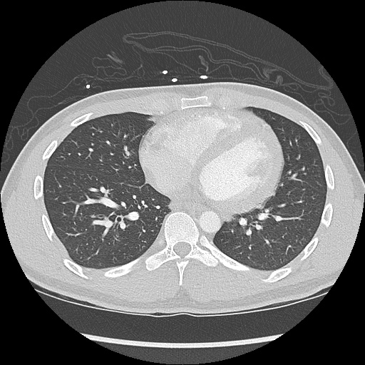 File:Active right ventricular cardiac sarcoidosis (Radiopaedia 55596-62101 Axial lung window 31).jpg
