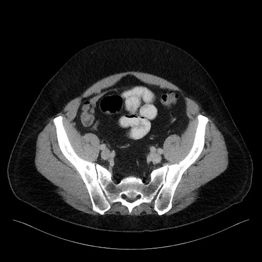 File:Acute-on-chronic pancreatitis (Radiopaedia 67286-76656 Axial C+ portal venous phase 63).jpg