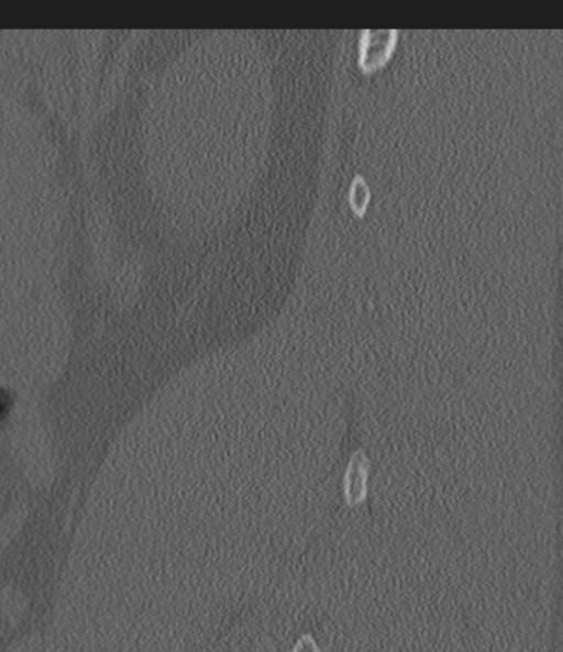 Acute L1 burst compression fracture (Radiopaedia 34430-35755 Sagittal bone window 56).png