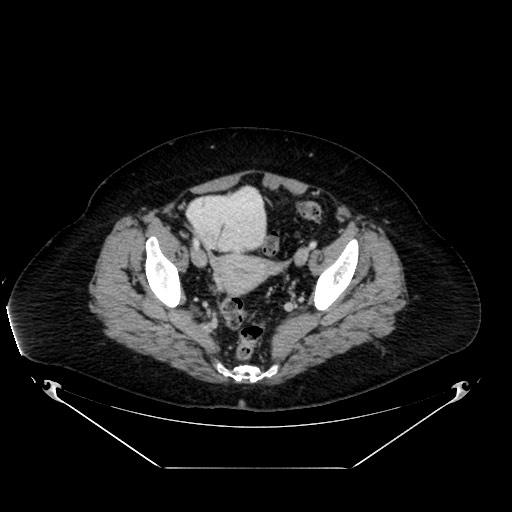 Acute appendicitis, heterotaxy syndrome (Radiopaedia 66884-76202 Axial C+ portal venous phase 110).jpg