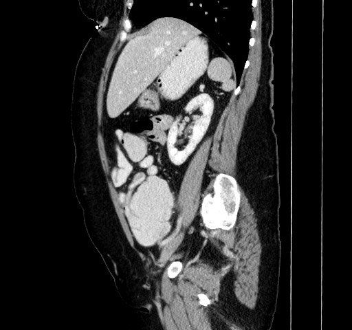 File:Acute appendicitis, heterotaxy syndrome (Radiopaedia 66884-76202 Sagittal C+ portal venous phase 51).jpg