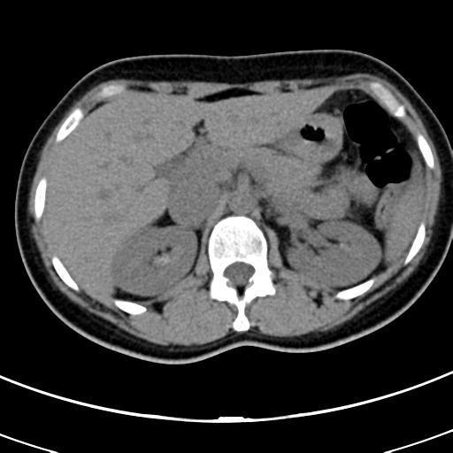 Acute appendicitis (Radiopaedia 30261-30888 Axial non-contrast 14).jpg