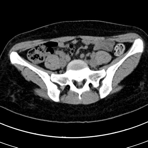 Acute appendicitis (Radiopaedia 30261-30888 Axial non-contrast 69).jpg