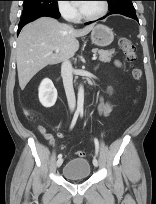 Acute appendicitis (Radiopaedia 36611-38177 Coronal C+ portal venous phase 32).png