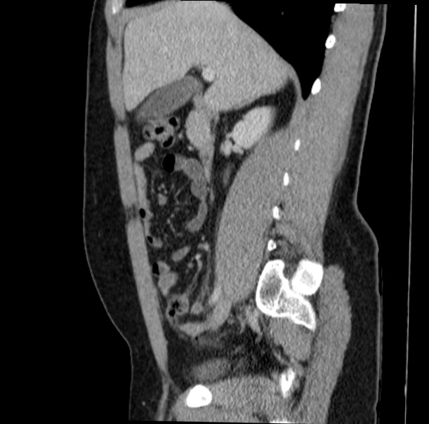Acute appendicitis (Radiopaedia 38255-40270 Sagittal C+ portal venous phase 32).jpg
