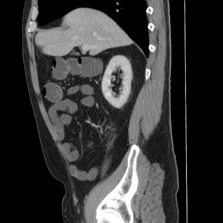 Acute appendicitis (Radiopaedia 66513-75790 Sagittal C+ portal venous phase 47).jpg