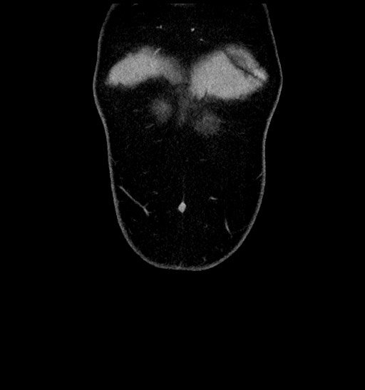 Acute appendicitis (Radiopaedia 77016-88960 Coronal C+ portal venous phase 14).jpg