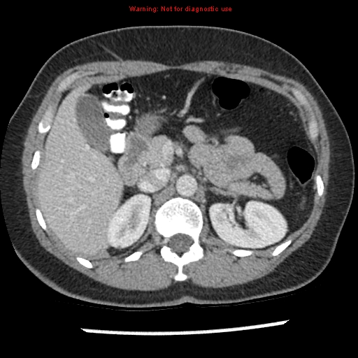 File:Acute appendicitis (Radiopaedia 7966-8812 C+ portal venous phase 10).jpg