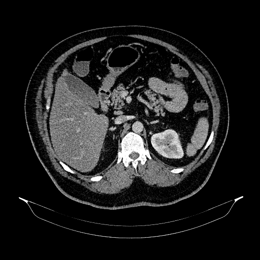 Acute appendicitis (Radiopaedia 79950-93224 Axial C+ portal venous phase 36).jpg
