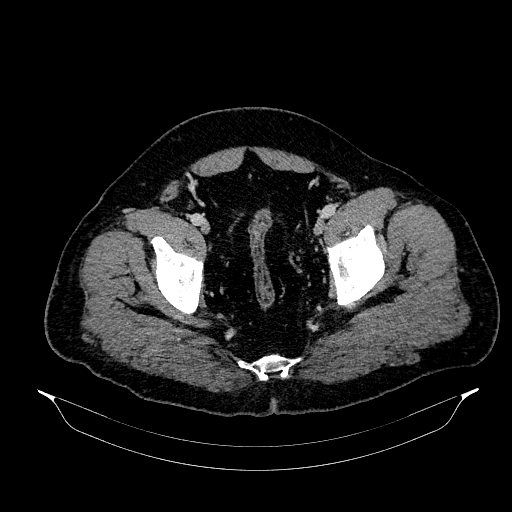 Acute appendicitis (Radiopaedia 79950-93224 Axial C+ portal venous phase 91).jpg