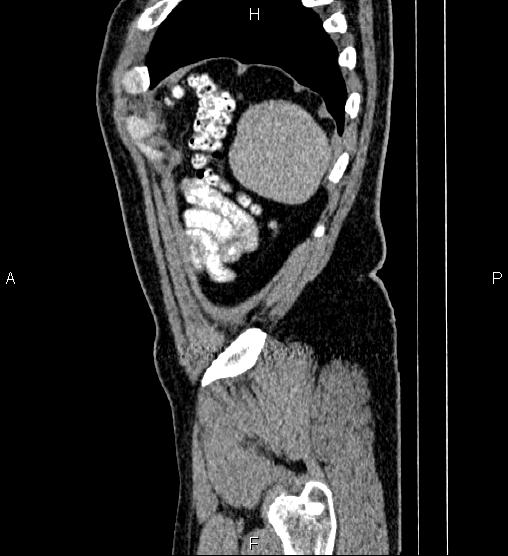 Acute appendicitis (Radiopaedia 84780-100240 Sagittal C+ portal venous phase 98).jpg