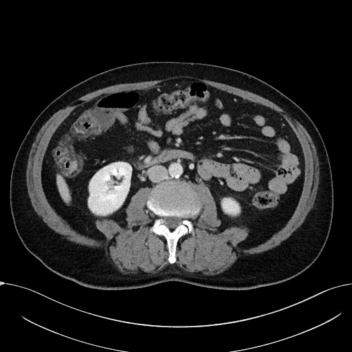 Acute appendicitis - large appendicoliths (Radiopaedia 61805-69820 Axial C+ portal venous phase 65).jpg