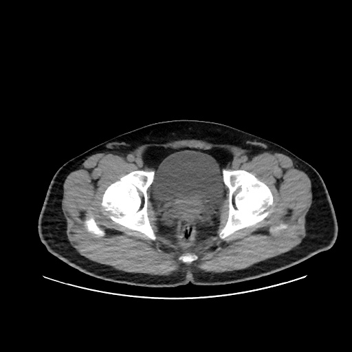 File:Acute appendicitis and COVID 19 pneumonia (Radiopaedia 76604-88380 Axial non-contrast 117).jpg