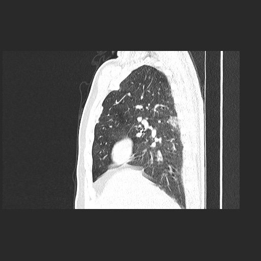Acute appendicitis and COVID 19 pneumonia (Radiopaedia 76604-88380 Sagittal lung window 32).jpg