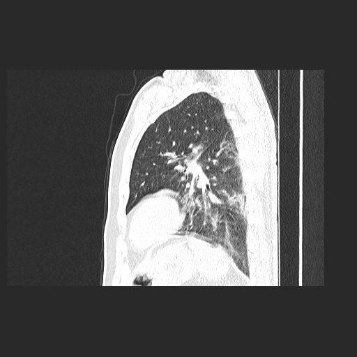 Acute appendicitis and COVID 19 pneumonia (Radiopaedia 76604-88380 Sagittal lung window 69).jpg