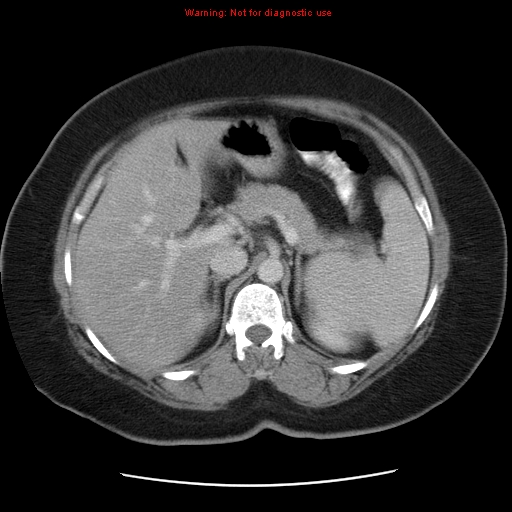 File:Acute appendicitis complicated by ovarian vein thrombophlebitis (Radiopaedia 16172-15851 Axial C+ portal venous phase 30).jpg