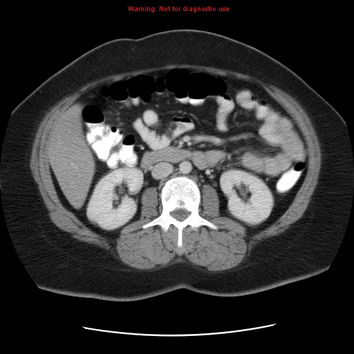 Acute appendicitis complicated by ovarian vein thrombophlebitis (Radiopaedia 16172-15851 Axial C+ portal venous phase 44).jpg