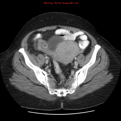Acute appendicitis complicated by ovarian vein thrombophlebitis (Radiopaedia 16172-15851 Axial C+ portal venous phase 73).jpg