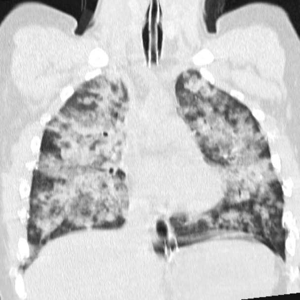 Acute aspiration pneumonitis (Radiopaedia 33605-34703 Coronal lung window 41).jpg