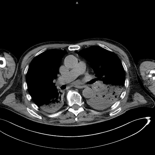 Acute aspiration pneumonitis (Radiopaedia 55642-62166 Axial liver window 31).jpg