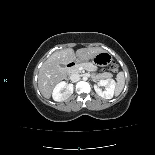 Acute bilateral pyelonephritis (Radiopaedia 37146-38881 Axial C+ portal venous phase 36).jpg