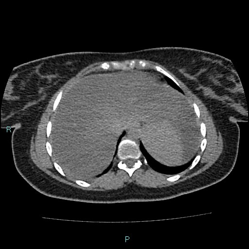 File:Acute bilateral pyelonephritis (Radiopaedia 37146-38881 Axial non-contrast 12).jpg