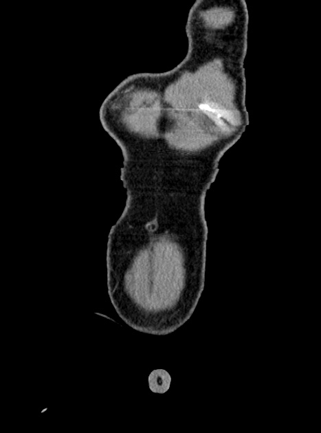 Acute bowel ischemia (Radiopaedia 87695-104114 Coronal C+ portal venous phase 62).jpg
