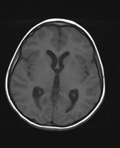 File:Acute cerebellar ataxia (Radiopaedia 61487-69446 Axial T1 12).jpg