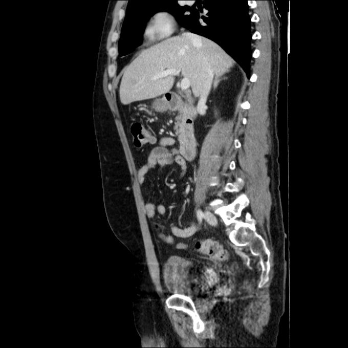 Acute cholecystitis and incidental left sided IVC (Radiopaedia 49352-54459 Sagittal C+ portal venous phase 55).jpg