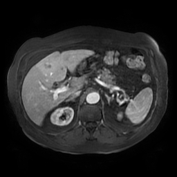 Acute cholecystitis complicated by pylephlebitis (Radiopaedia 65782-74915 Axial arterioportal phase T1 C+ fat sat 51).jpg