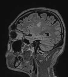 Acute disseminated encephalomyelitis (ADEM)- Anti-NMDA receptor encephalitis (Radiopaedia 54920-61201 Sagittal FLAIR 29).png