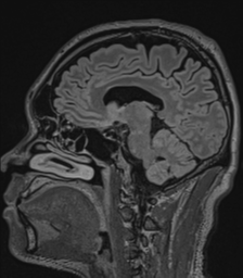 Acute disseminated encephalomyelitis (ADEM)- Anti-NMDA receptor encephalitis (Radiopaedia 54920-61201 Sagittal FLAIR 40).png