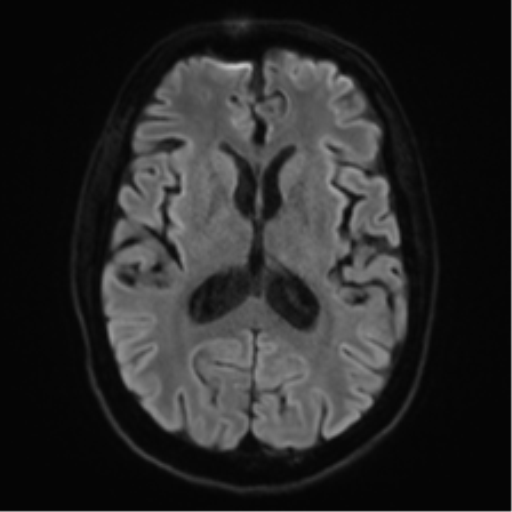 File:Acute disseminated encephalomyelitis (ADEM) (Radiopaedia 65319-74350 Axial DWI 17).png