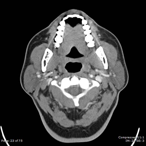 File:Acute epiglottitis (Radiopaedia 54375-60590 Axial C+ arterial phase 23).jpg