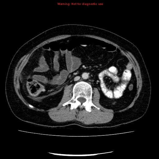 File:Acute gangrenous cholecystitis (Radiopaedia 10123-10661 Axial C+ portal venous phase 52).jpg