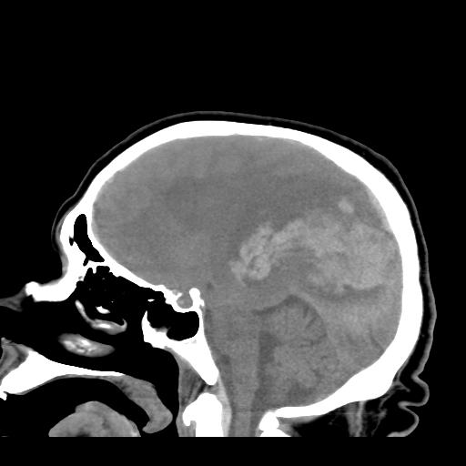 File:Acute hemorrhagic stroke (Radiopaedia 17507-17223 Sagittal non-contrast 21).jpg